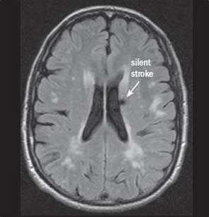 Don't make stroke your silent killer -MRI