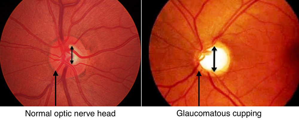 Glaucoma: The Silent Thief of Sight - Optic nerve cupping
