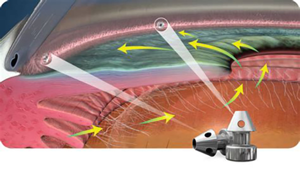 Glaucoma: The Silent Thief of Sight - Istent inject