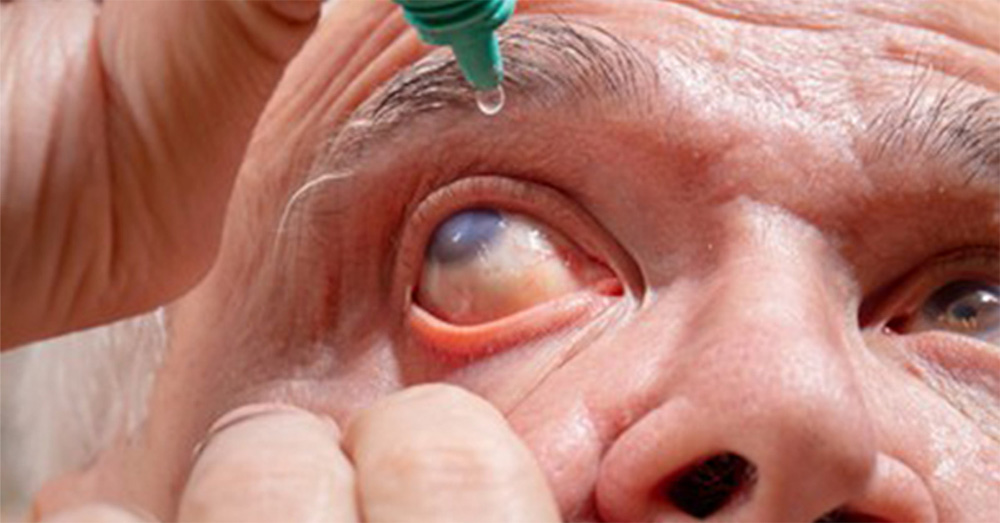 Glaucoma: The Silent Thief of Sight - Prescription eye drops