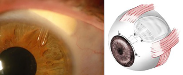 Glaucoma: The Silent Thief of Sight - Tube-shunt