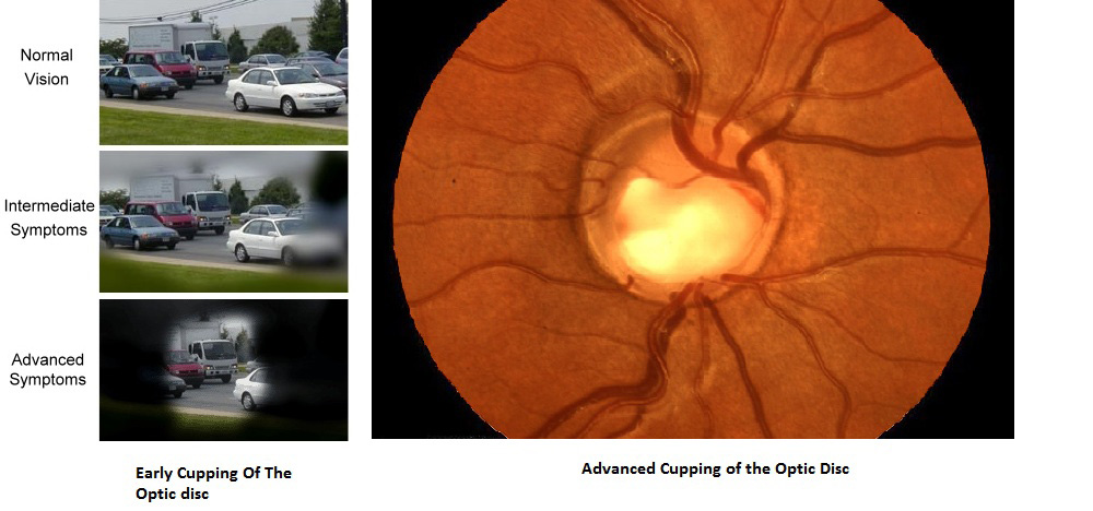 Glaucoma: The Silent Thief of Sight - Effects