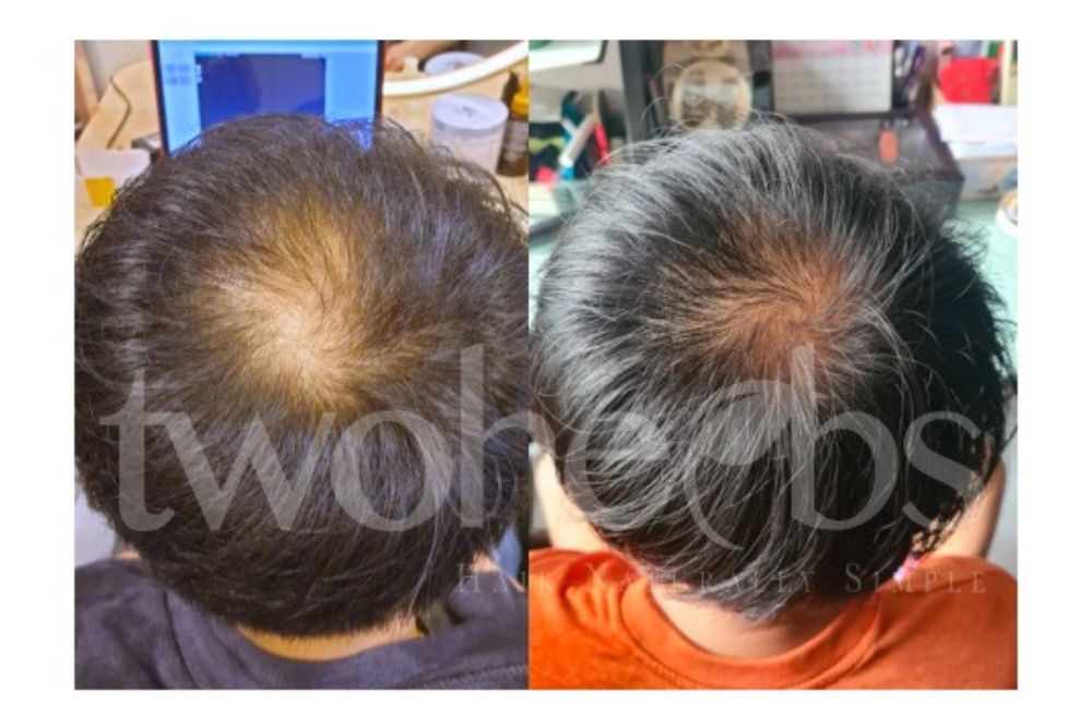 Getting To The Root Of Hair Loss With Herbal Treatments - Before and After Treatment