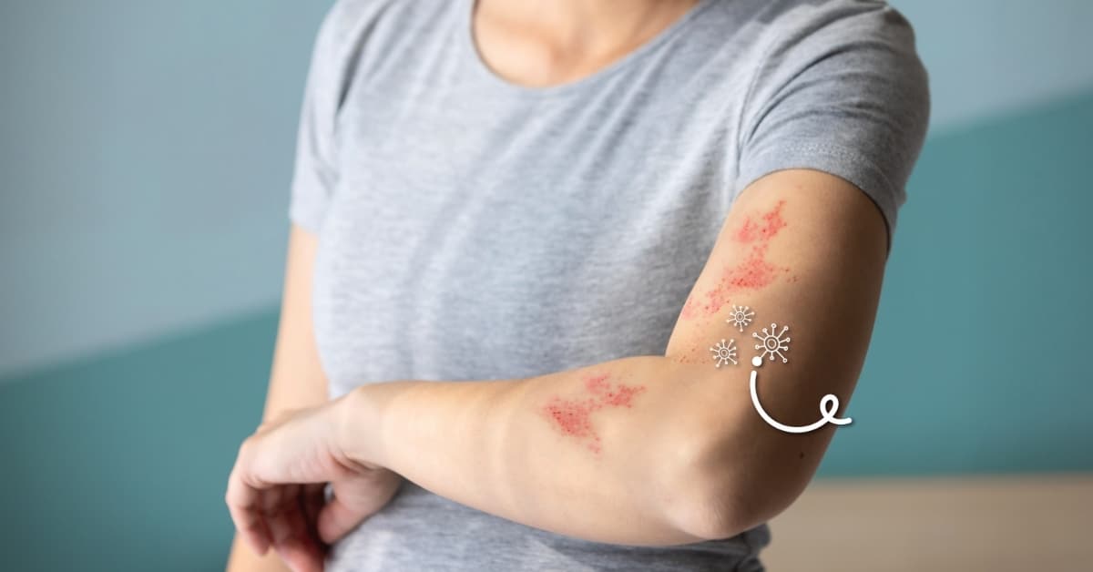 Shingles: Symptoms, Risks, And New Vaccine Subsidies For Seniors In Singapore