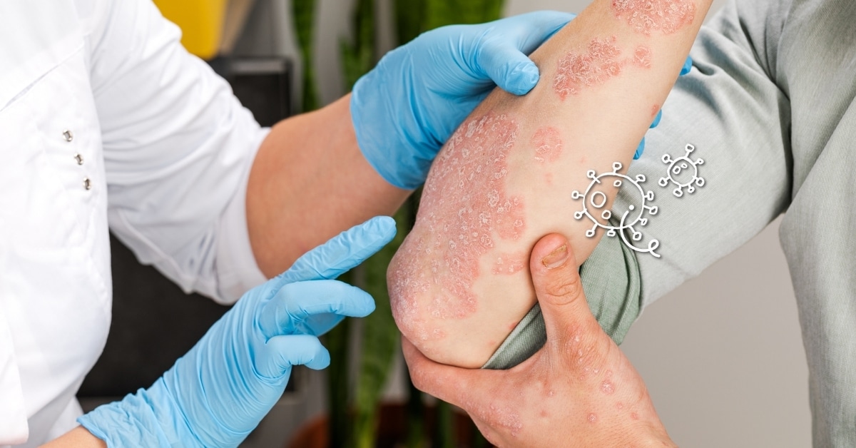 Eczema: Are We More Prone To It As We Get Older?